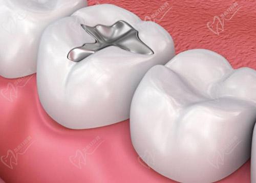 复合树脂和固体树脂补牙使用年限的区别