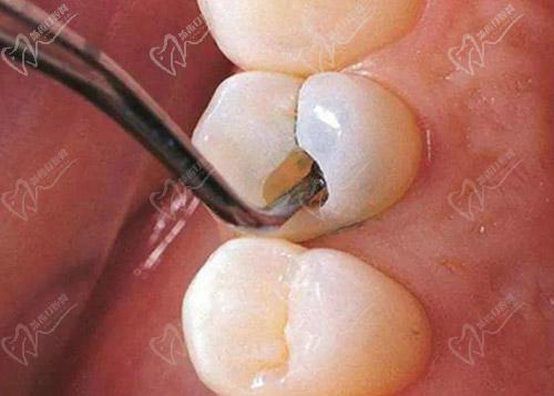 复合树脂和固体树脂补牙操作方法的区别