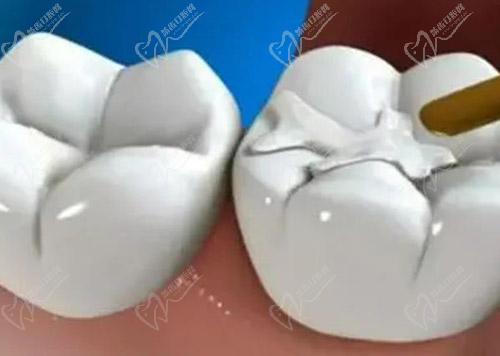 复合树脂和固体树脂补牙使用范围的区别