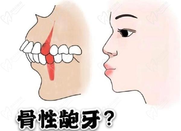 中度骨性畸形，骨性龅牙