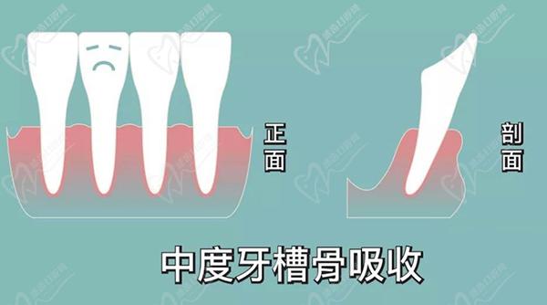 掩饰性正畸的缺点，牙槽骨吸收