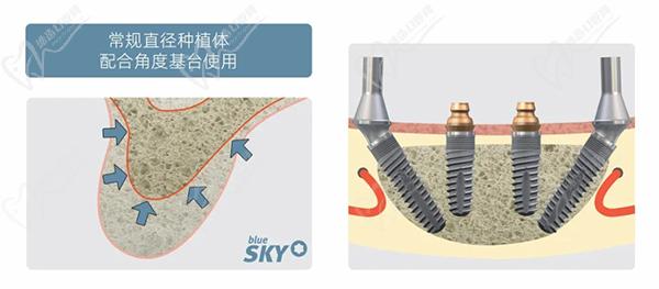 德国sky种植体优点