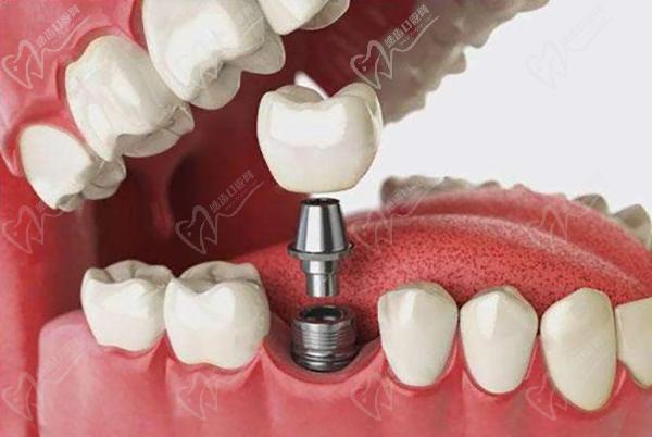 西安市种植牙医院排名—西安弗莱堡（原碑林美奥）口腔种植牙费用