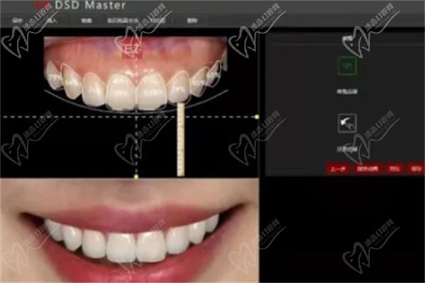 DSD微笑美学设计仪器