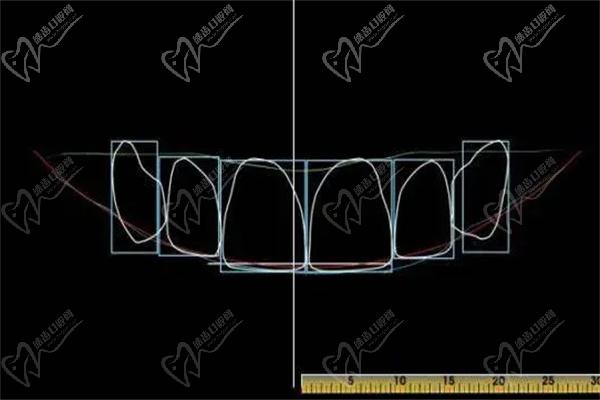 DSD微笑美学量齿裁定