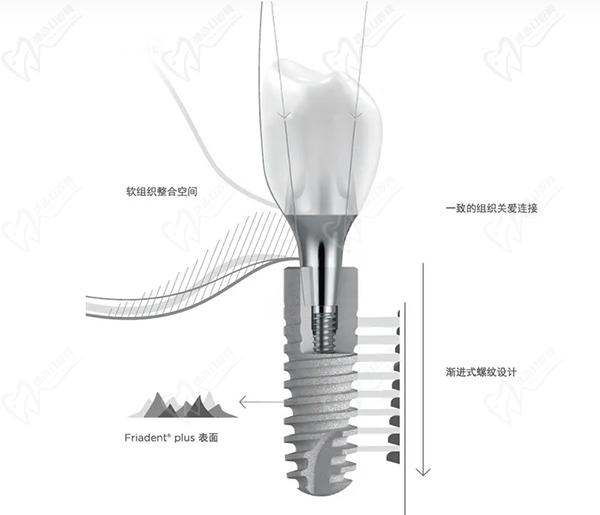 德国费亚丹种植牙好吗