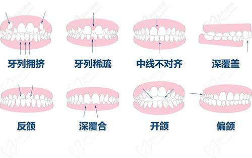 隐适美隐形矫正适应症