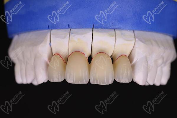 国产爱尔创氧化锆全瓷牙好