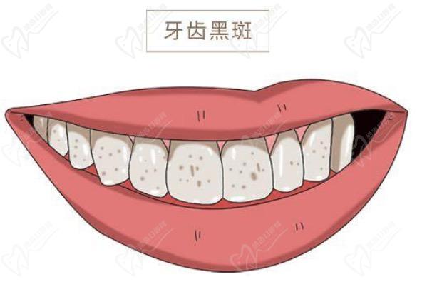 牙齿缝隙中间有黑色的是不是蛀牙？