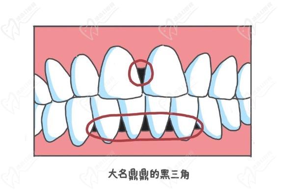 牙齿缝隙中间有黑色的是不是蛀牙？