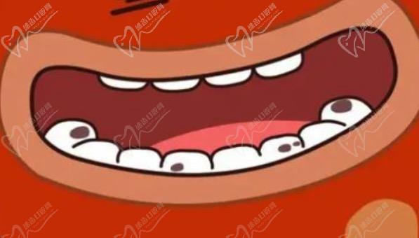 牙齿缝隙中间有黑色的是不是蛀牙？