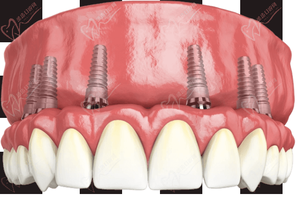进口全瓷牙冠品牌及价格表