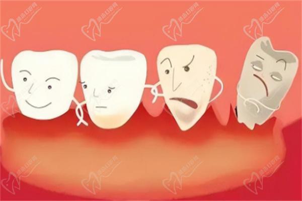 牙周炎导致牙齿脱落无法再植