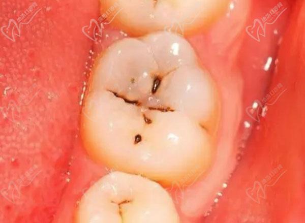 早期龋齿图片