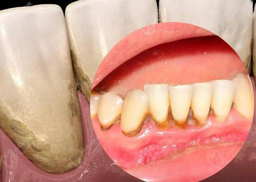 正畸牙根吸收症状有哪些