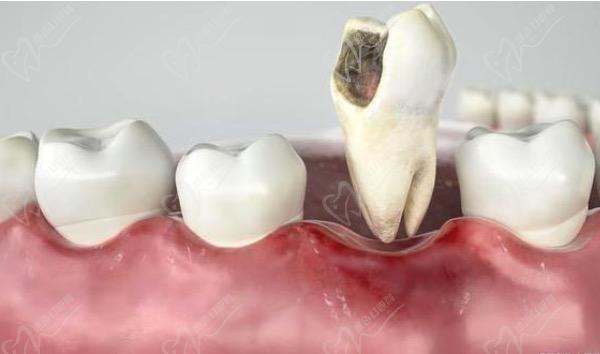 治疗牙周炎后需要植入骨粉吗？