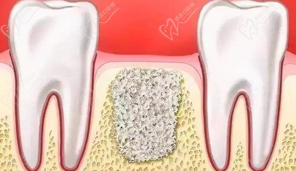 治疗牙周炎后需要植入骨粉吗？