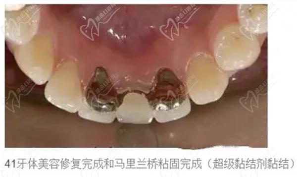 牙齿修复