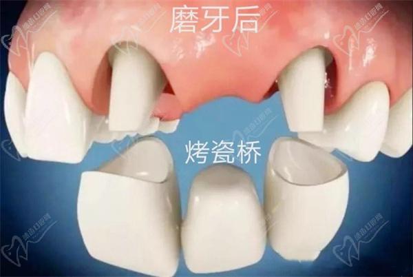 牙齿修复