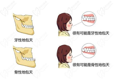 乳牙反颌矫正方法是什么