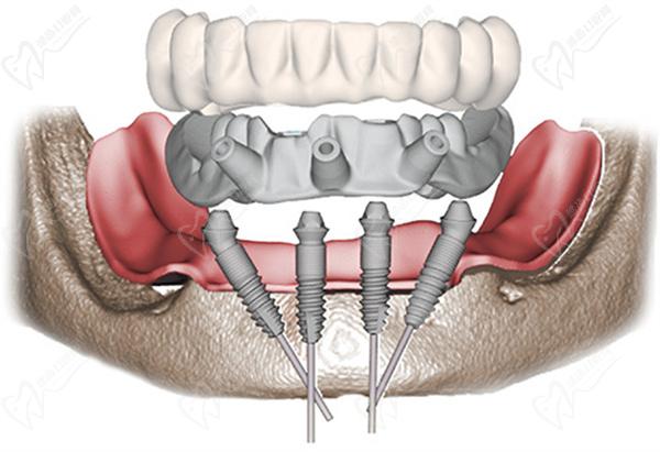 all-on-4种植牙