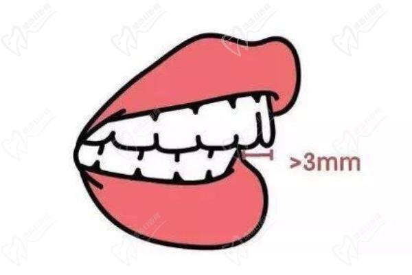 牙齿很整齐为什么会嘴突呢？