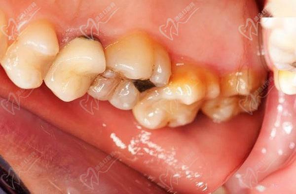 牙髓息肉会癌变吗