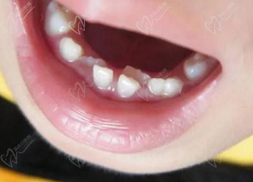儿童换牙锯齿状原因