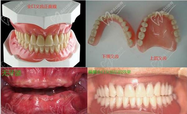 钢托假牙和胶托假牙哪个舒服？从钢托假牙和胶托假牙区别来看