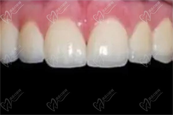 德国义获嘉美白牙贴