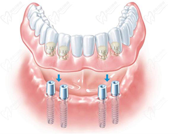 All-on-4种植牙