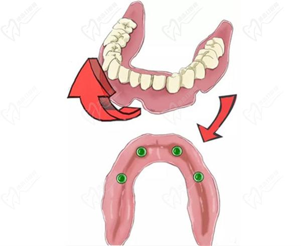 All-on-4种植牙