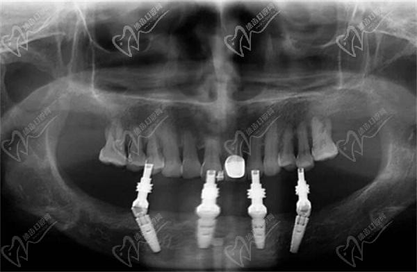 All-on-4种植牙