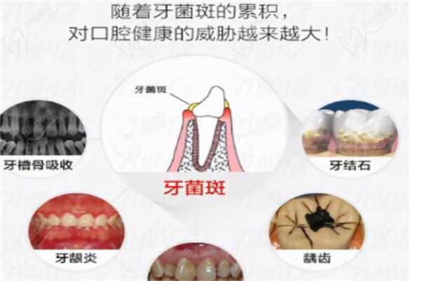 牙菌斑的危害