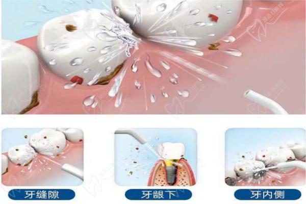 定期洁牙除掉牙齿凹槽黑色