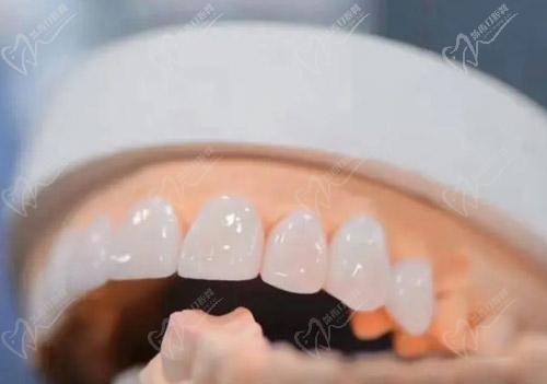 树脂牙冠和全瓷牙冠区别有哪些 树脂牙冠和全瓷牙冠区别有哪些