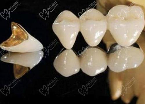 树脂牙和全瓷牙哪个好 树脂牙和全瓷牙哪个好