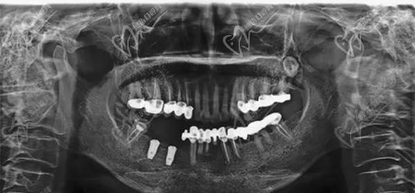 种植牙X线检查