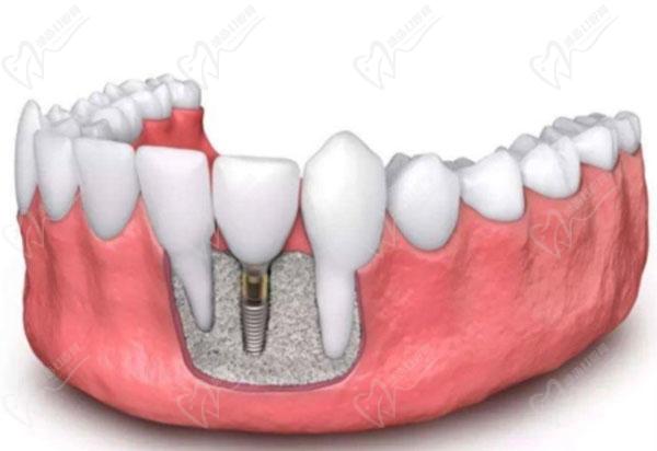 种植牙的外观应与自然牙相似，这也是种植牙成功的判断标准之一