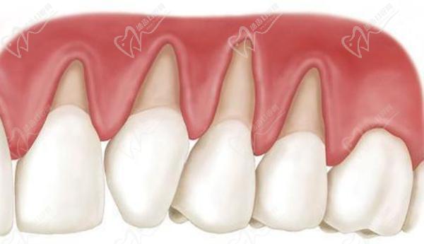 牙龈萎缩是什么原因