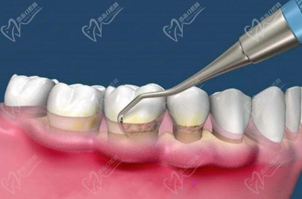 牙龈萎缩是什么原因
