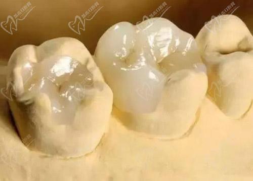 纳米树脂补牙的优缺点有哪些