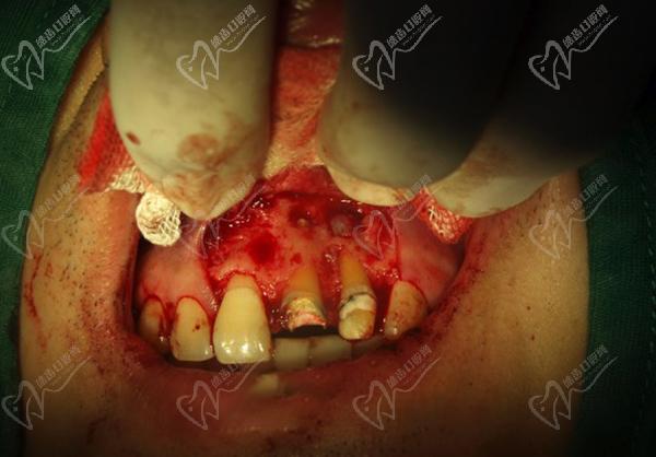 牙龈癌的早期三大症状和表现：牙齿松动、牙龈出血、牙龈肿块