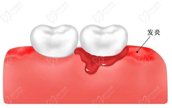 牙龈癌的早期三大症状和表现：牙齿松动、牙龈出血、牙龈肿块