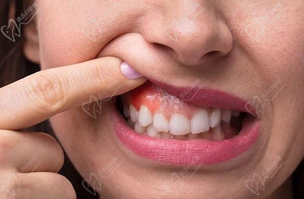 如何修复萎缩的牙龈