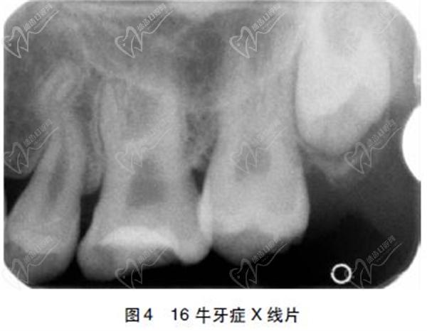 牛牙症