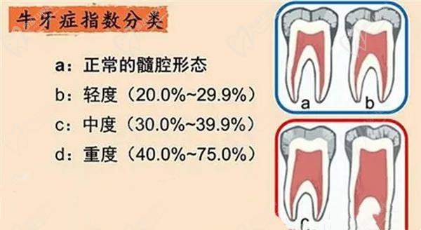 牛牙症