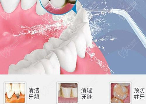牙齿是否需要定期洗牙