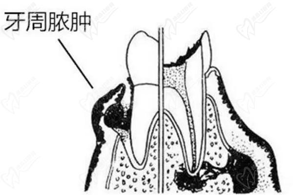 牙周脓肿示例图