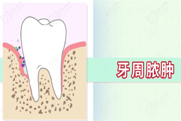 牙周脓肿怎么治疗